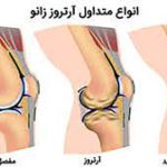 آرتروز در پرندگان